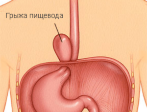 Грыжа пищевода и полип желудка