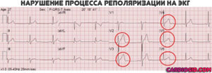 Неспецифические изменения фазы реполяризации на ЭКГ для мвд