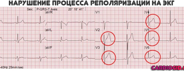 Неспецифические изменения фазы реполяризации на ЭКГ для мвд