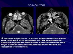 Нерезкое нарушение пневматизации ячеек основной пазухи