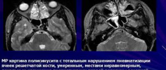 Нерезкое нарушение пневматизации ячеек основной пазухи