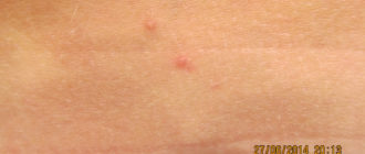 Парные сильно зудящие прыщи