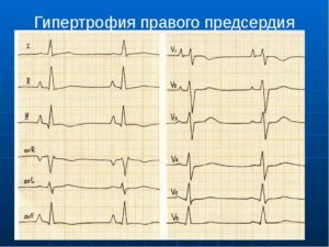 Гипертрофия правого предсердия