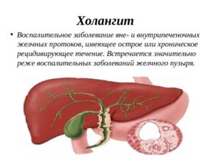 Холангит у ребенка