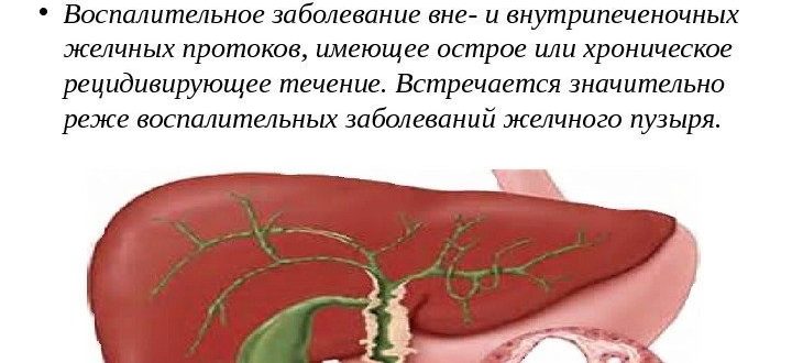 Болезнь желчных протоков. Холангит желчного пузыря. Острый холангит желчный пузырь. Воспаление желчных ходов. Аутоиммунные заболевания желчного пузыря.