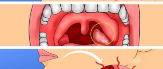 Опухоль ниже миндалины