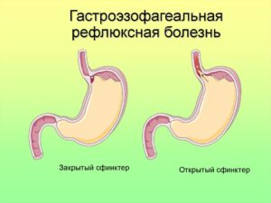 Гастроэзофагеальная рефлюксная болезнь