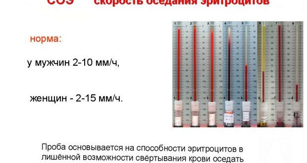 Очень высокая СОЭ и субфебрилитет