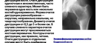 Отек костного мозга в теле левой подвздошной кости