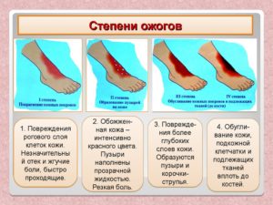 Ожог! Подскажите, правильно ли я всё делаю?