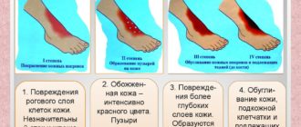 Ожог! Подскажите, правильно ли я всё делаю?