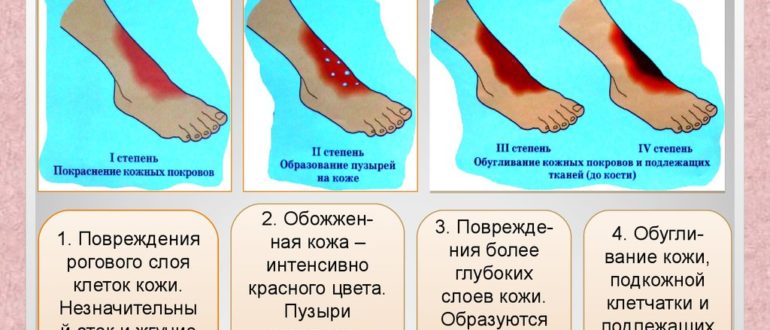 Ожог! Подскажите, правильно ли я всё делаю?