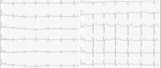 Неопределенная фронтальная ось QRS на экг