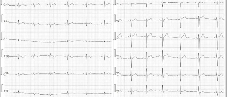 Неопределенная фронтальная ось QRS на экг