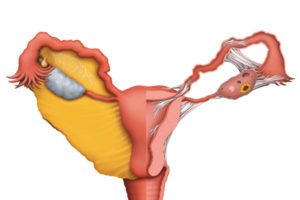 Гипоплазия матки, СИЯ под вопросом, дисфункция яичников