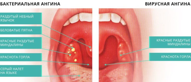 Гнойники в горле без боли