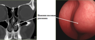 Отек носовых раковин