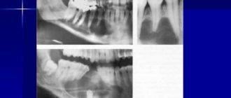 Гигантоклеточная гранулема