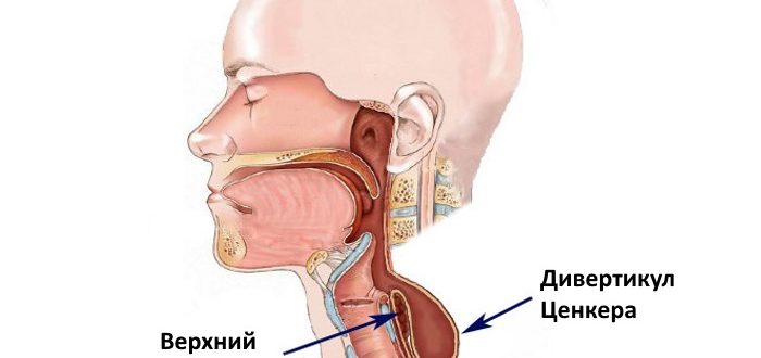 Ощущение застрявшей таблетки в горле