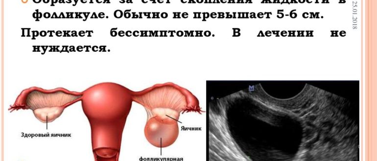 Фолликулярная киста и лечение