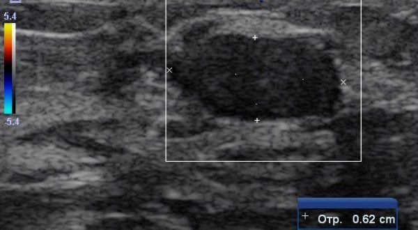 Фиброаденома, цветовые сигналы при исследовании цветным допплером