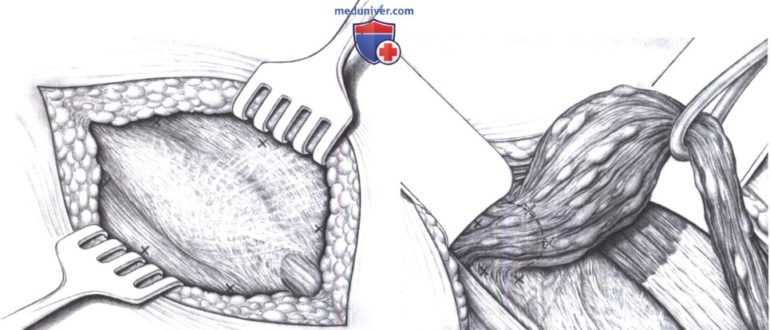 Паховая грыжа под местным наркозом