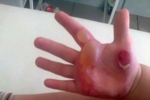 Ожог руки у ребенка