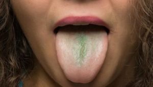 Хронические зеленые сопли, налет на языке запах
