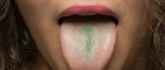 Хронические зеленые сопли, налет на языке запах