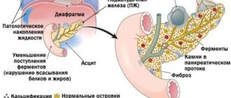 Геморой и хронический панкреатит