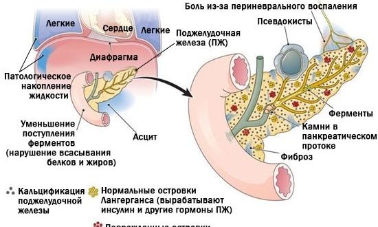 Геморой и хронический панкреатит