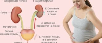 Гидронефроз при беременности