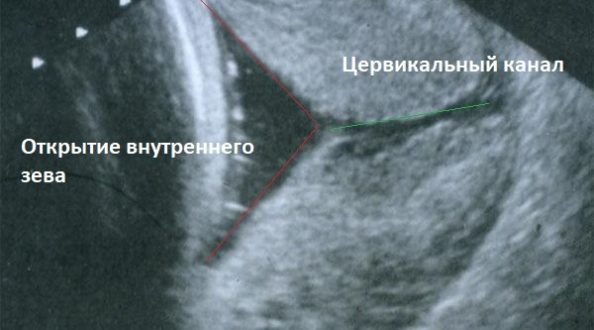 Открытие внутреннего зева