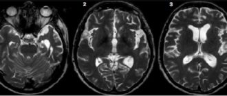 Нейросифилис МРТ признаки