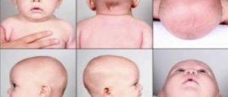 Форма головы ребёнка 3 месяца