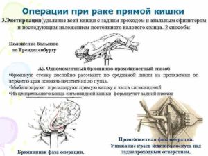 Операция на прямой кишке-онкология