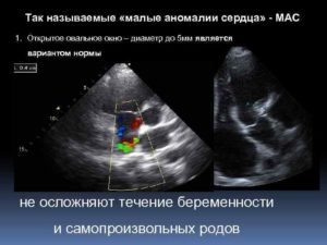 Открытое овальное окно при беременности