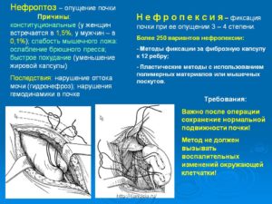 Нефроптоз и его последствия