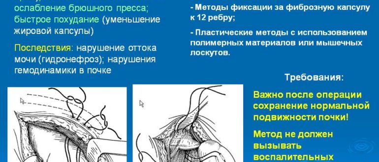 Нефроптоз и его последствия