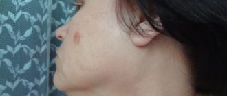 Опухоли рядом с ухом и щекой с двух сторон
