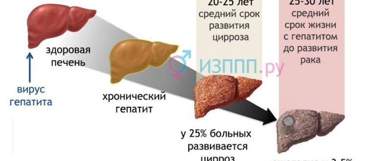 Гепатит С продолжительность 25 лет