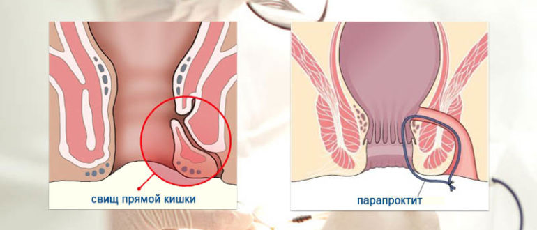 Геморрой или парапроктит