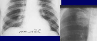 Образование верхней доли правого легкого