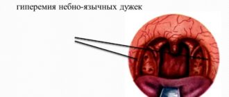 Гиперемия нежных дужек у ребенка