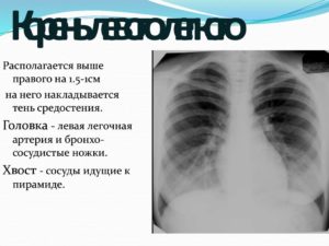 Образование в головке корня левого лёгкого