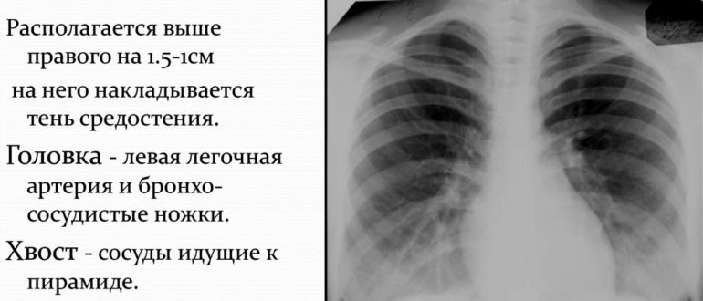 Образование в головке корня левого лёгкого