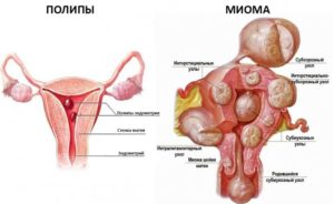 Фитотерапия при полипе эндометрия и миоме