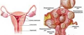 Фитотерапия при полипе эндометрия и миоме