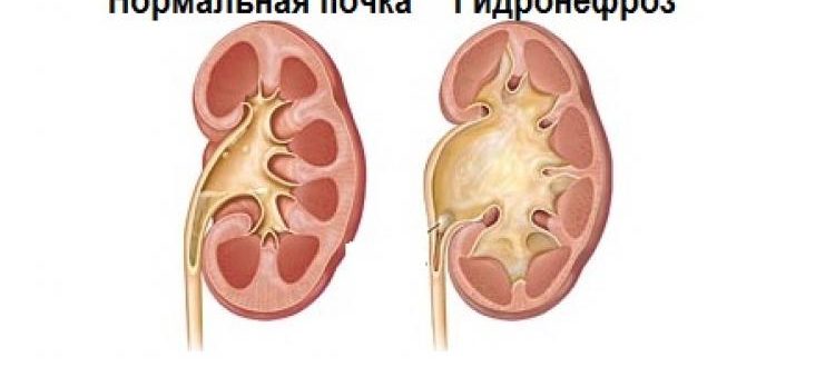 Гидронефроз и прививки