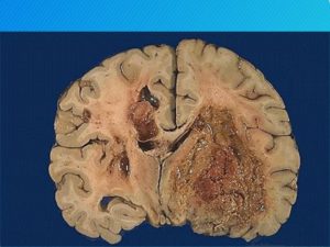 Глиобластома 4 стадии